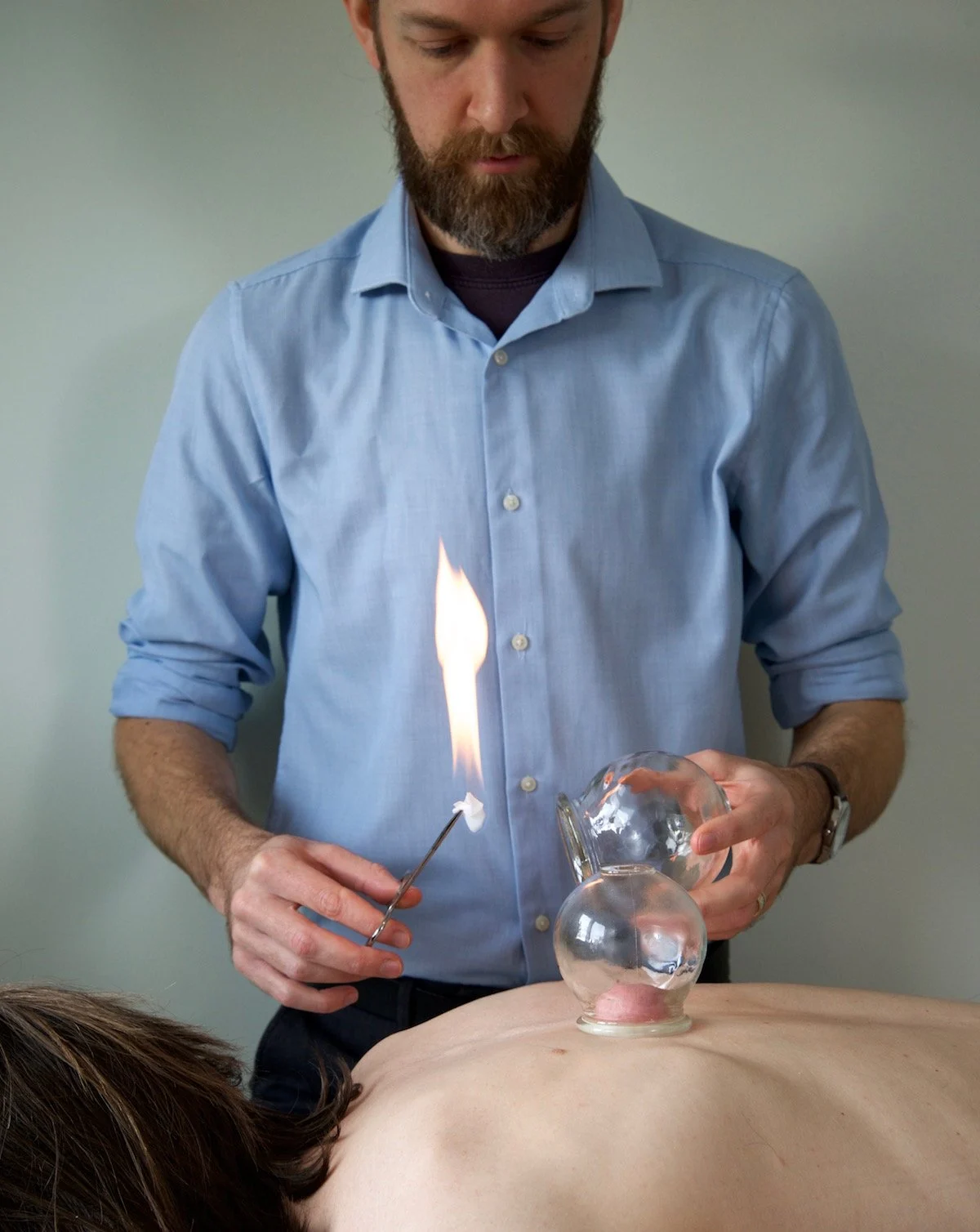 cupping cupping